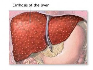 liver_disease